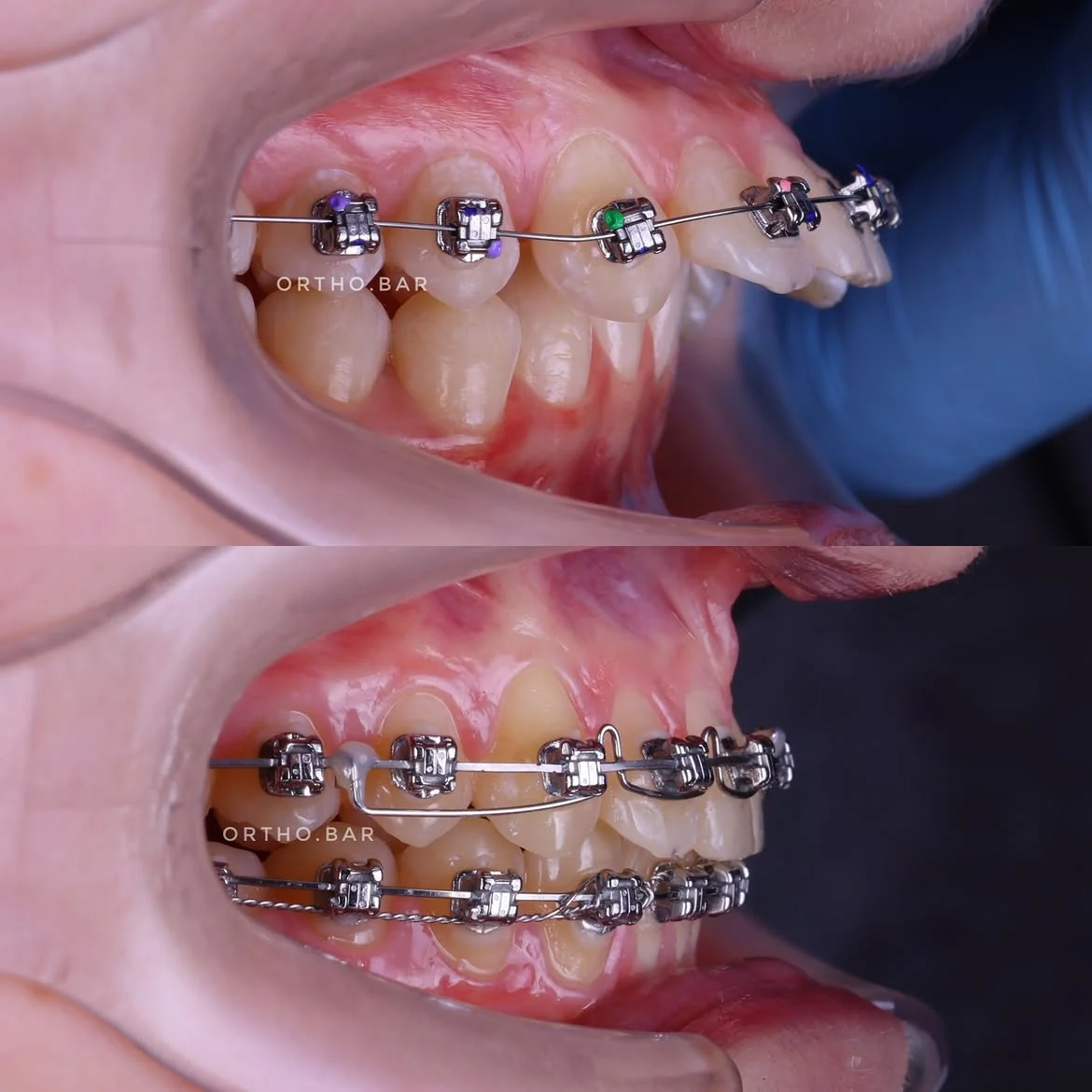 Дистализация верхнего ряда — кейс ORTHO.BAR