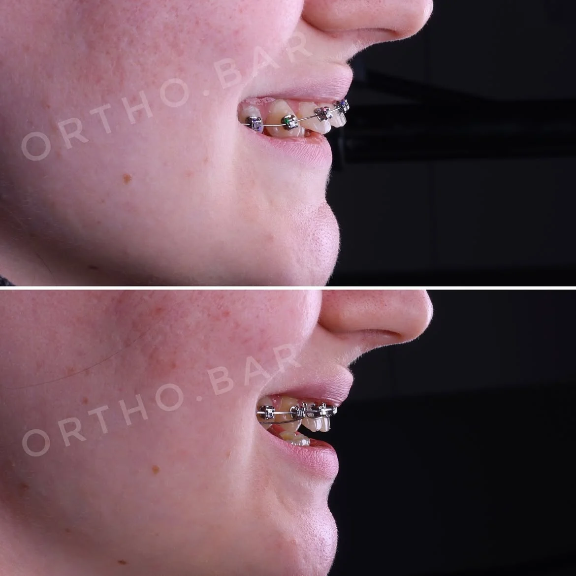 Дистализация верхнего ряда: фото 2 — ORTHO.BAR