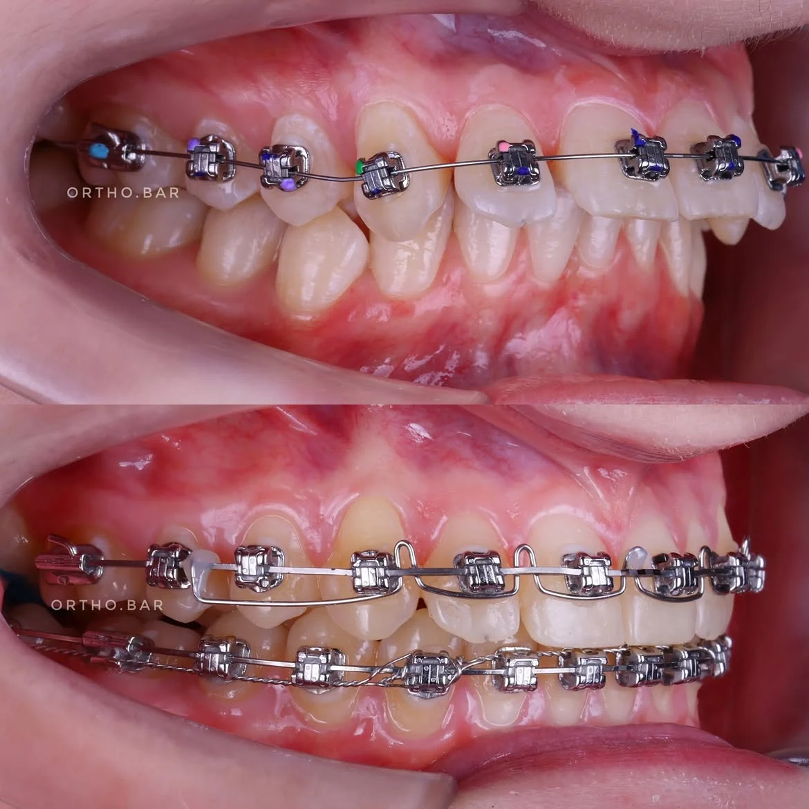 Дистализация верхнего ряда: фото 3 — ORTHO.BAR
