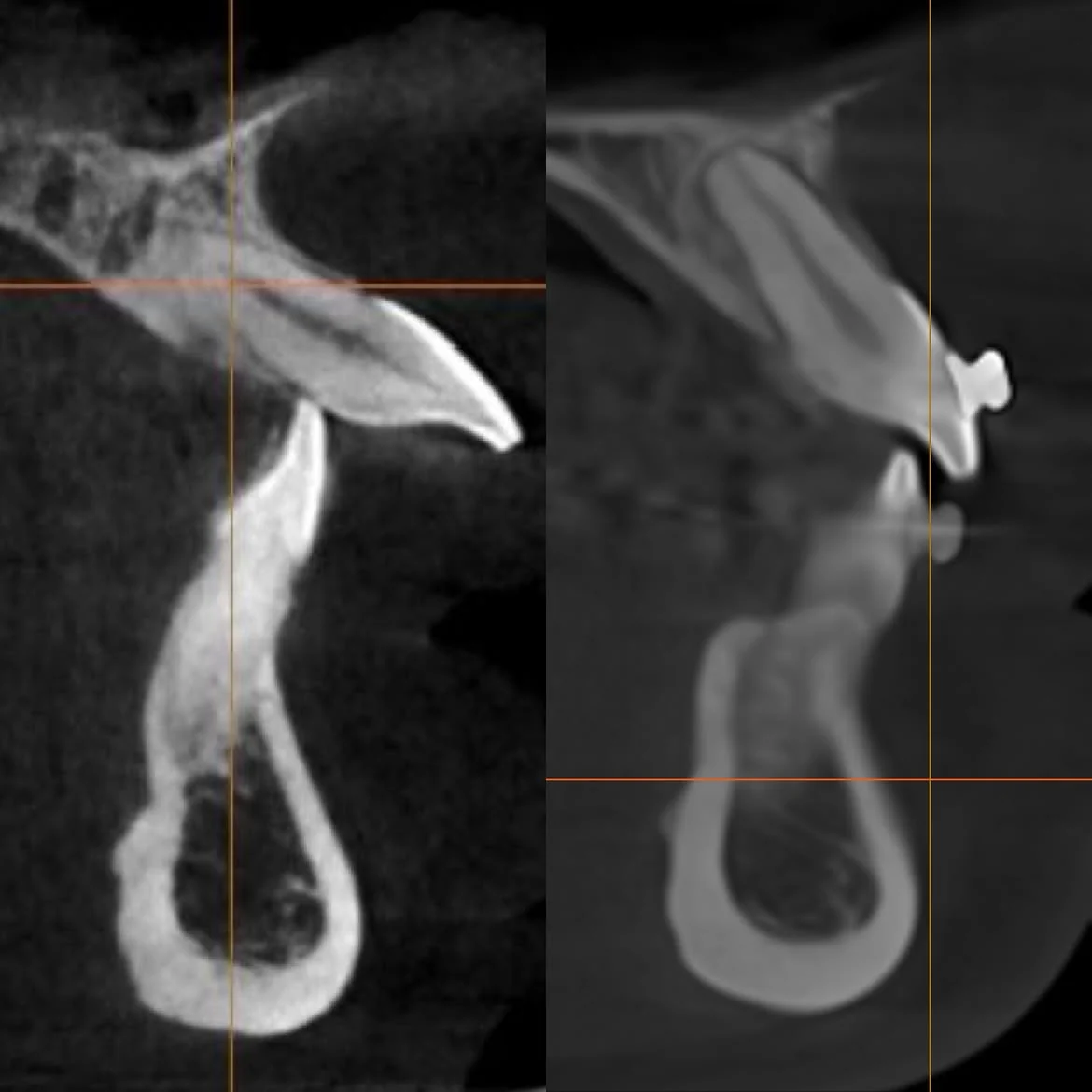 Дистализация верхнего ряда: фото 4 — ORTHO.BAR