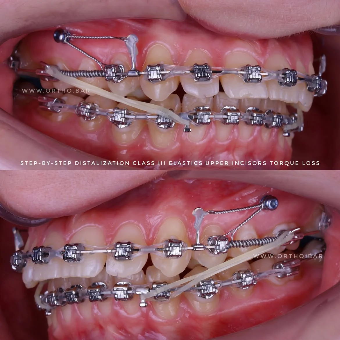 Дистализация верхнего ряда: фото 6 — ORTHO.BAR