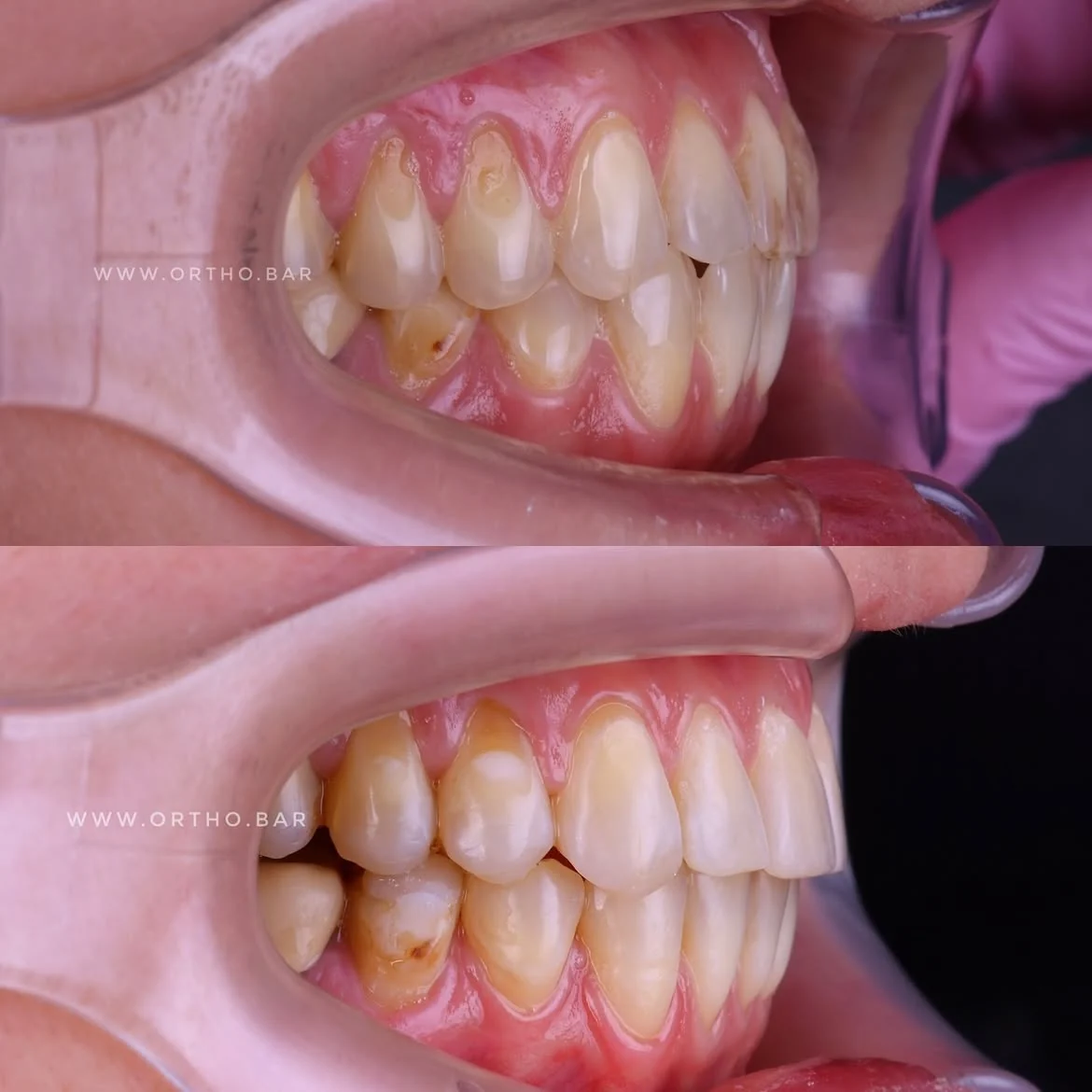 Подготовка к протезированию: фото 2 — ORTHO.BAR