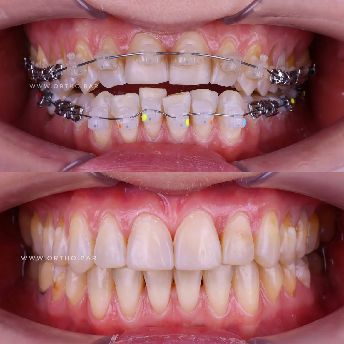 Подготовка к протезированию: фото 4 — ORTHO.BAR
