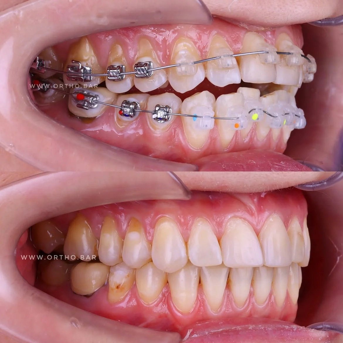 Подготовка к протезированию: фото 5 — ORTHO.BAR