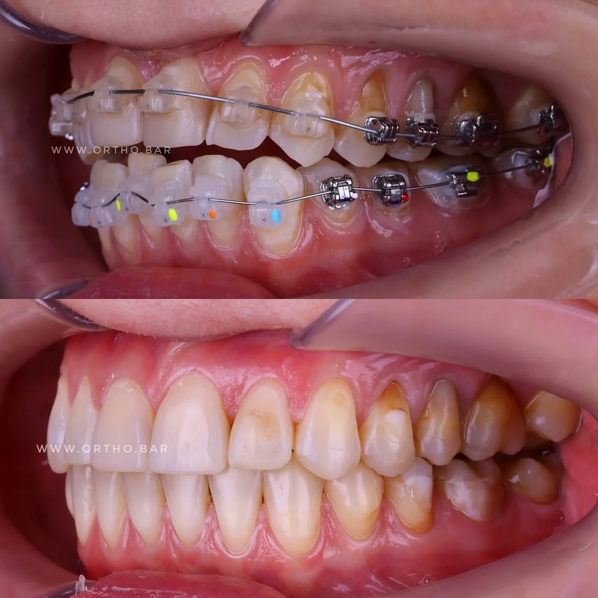 Подготовка к протезированию: фото 6 — ORTHO.BAR