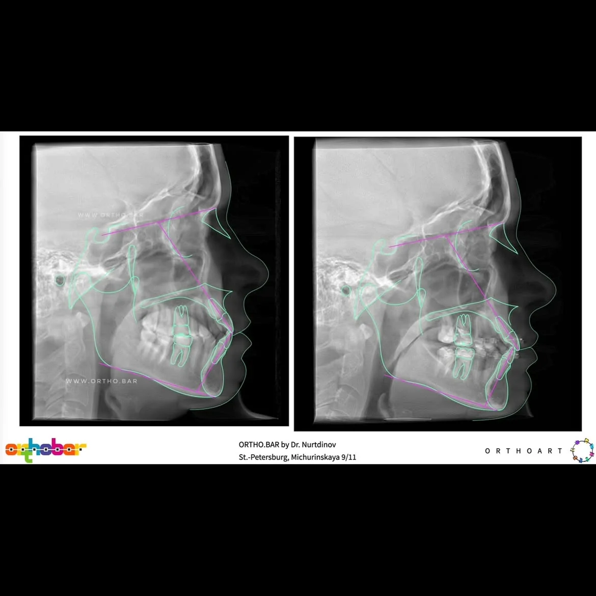 Подготовка к протезированию: фото 9 — ORTHO.BAR