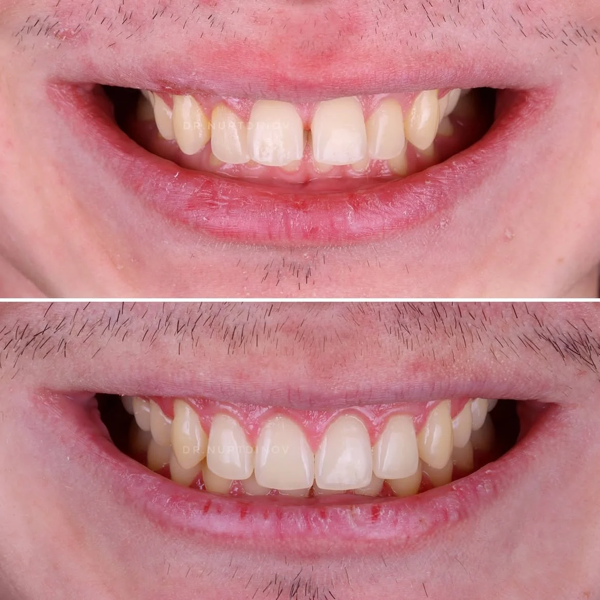 Исправление прикуса II класса: фото 2 — ORTHO.BAR