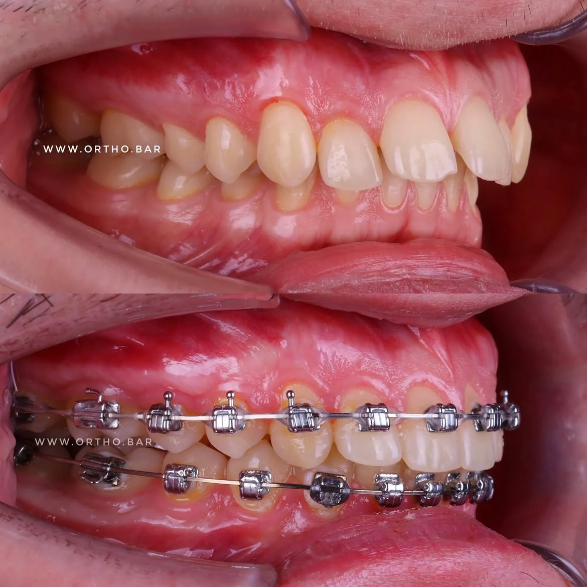Исправление прикуса II класса: фото 6 — ORTHO.BAR