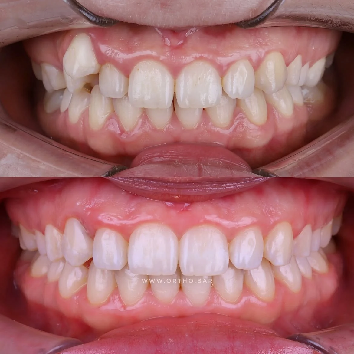 Лечение с удалением шестого зуба: фото 2 — ORTHO.BAR