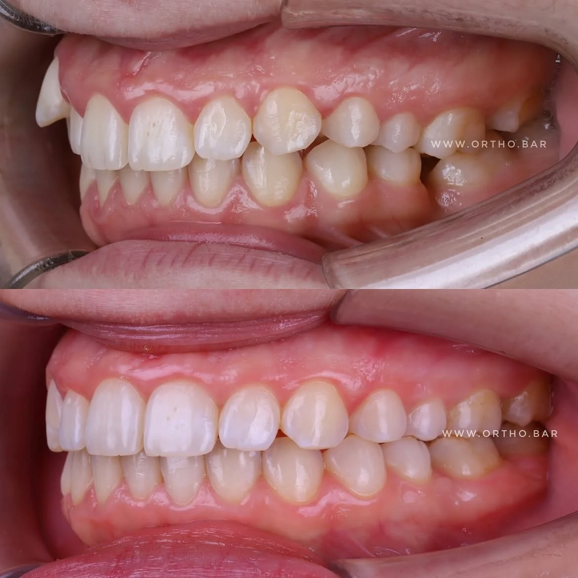 Лечение с удалением шестого зуба: фото 3 — ORTHO.BAR