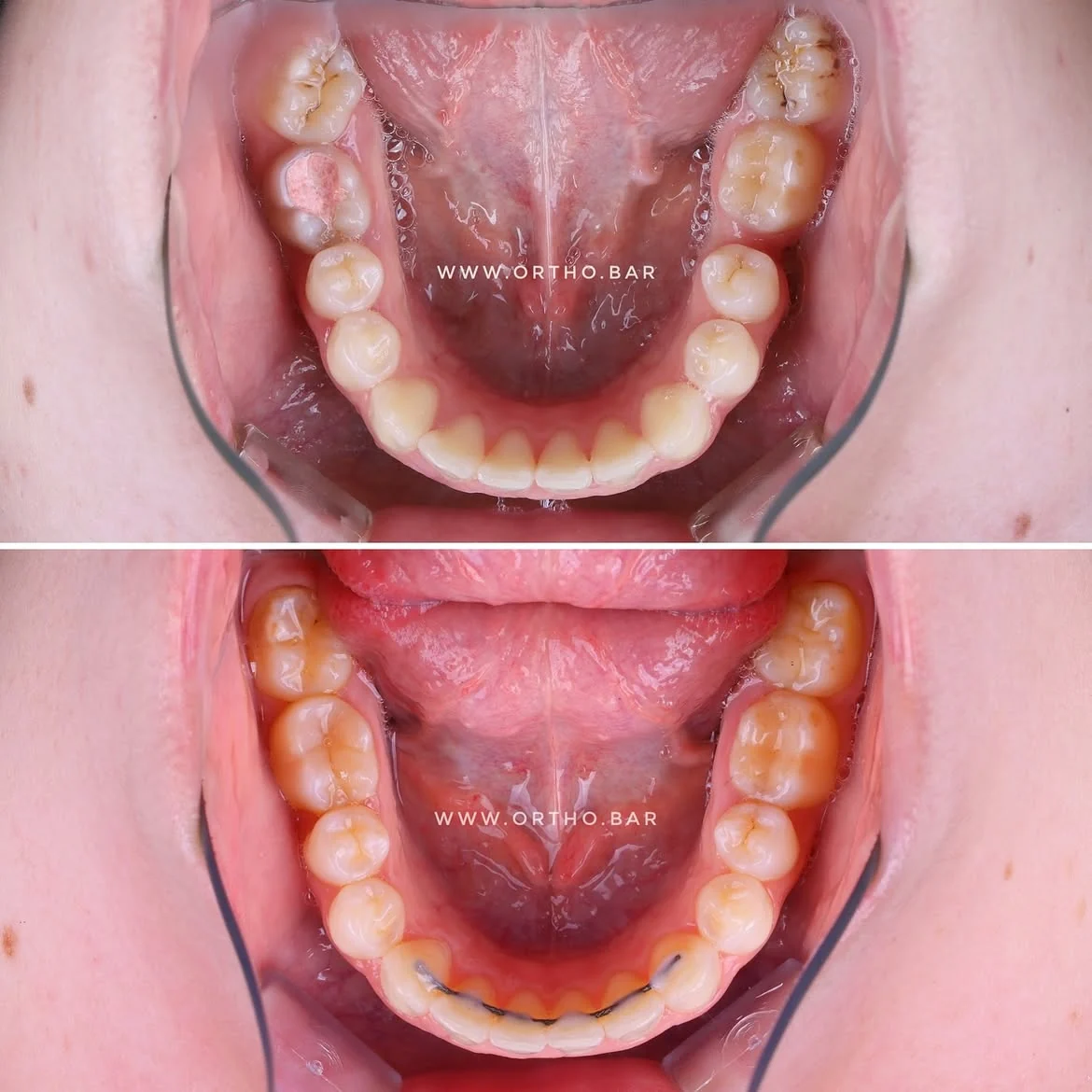 Лечение с удалением шестого зуба: фото 6 — ORTHO.BAR